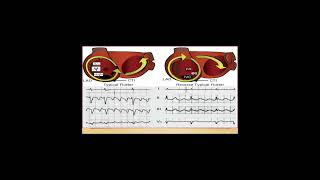 Blocs sinoauriculaires et Blocs auriculoventriculaires BSA et BAV Dr Laidi  Cardio [upl. by Akined224]