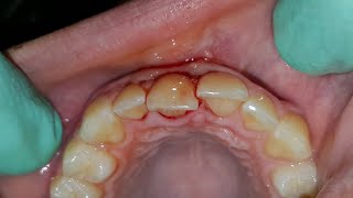 Dental trauma  Management of Lateral Luxation [upl. by Irneh]