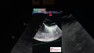 Perimembranous VSD  VSD  congenital heart anomalies  VSD Echo [upl. by Neeloj]