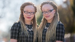 Twins With Albinism Wear Their Condition With Style  SHAKE MY BEAUTY [upl. by Eaves]