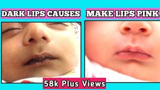 Baby lips black after feeding  The Causes of Dark Lips in Babies  How to make baby lips pink [upl. by Merriman]