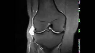 Meniscal and parameniscal cyst [upl. by Fabrin]