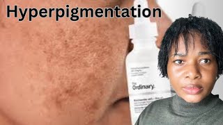 ULTIME GUIDE TRAITEMENT et Routine de Soins HYPERPIGMENTATION pour un TEINT CLAIRE sans TÂCHES [upl. by Ahsir]