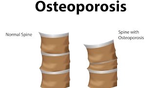 What is Osteoporosis [upl. by Misti]