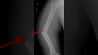 Transverse fracture through the midshaft of the right humerus xray [upl. by Goodrow]