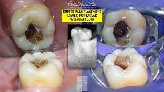 rubber dam placement mandibular third molar wisdom tooth w14a hu friedy multiple teeth maxidam [upl. by Anella]