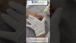 Best Clinic for Wart Removal Treatment at BodyClinix  Quick amp Effective Solutions [upl. by Boylston]