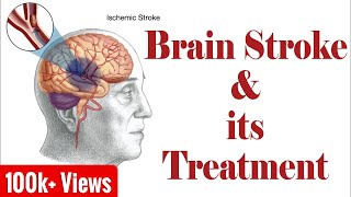 Ischemic Brain Stroke amp Haemorrhagic Brain Stoke Treatment [upl. by Eseila]