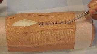 Suture Removal  simple interrupted [upl. by Mihcaoj]