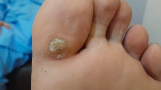 Wart Remove treatment Continue part oneskin facial skincare healthfootdoctor nailsfootcallous [upl. by Humbert]