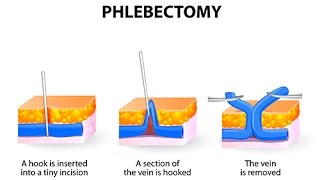 Comment soigneton une phlébite [upl. by Anyrtak]