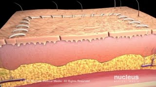 SKIN GRAFTING PLASTIC AND RECONSTRUCTIVE SURGERY [upl. by Prussian619]