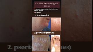 Dermatological signs papules acne acnetreatment psoriasis plaques [upl. by Lindemann]