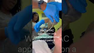 Wound VAC Application woundcare woundvac npwt [upl. by Ulphiah]