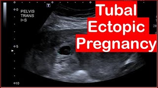 Ultrasound Diagnosis Of Tubal ectopic pregnancy [upl. by Airotciv]