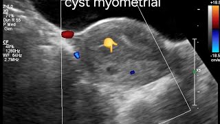 Ultrasound Imaging of Posterior Wall Myometrial Cyst with Adenomyosis Features in a globular Uterus [upl. by Billmyre]