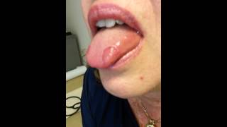 Geographic tongue [upl. by Emmy]