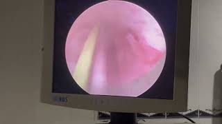 Urethral Stricture treated by DVIU [upl. by Arres688]