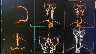 MR Angiography amp Venography carotid and brain contrastcare bolusSiemens 3THMS MIRDIF HOSPITALUAE [upl. by Isolda]