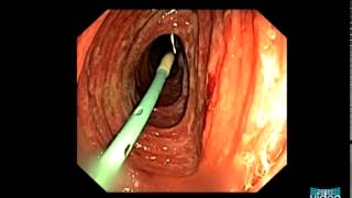 Vascular Lesions in the Small Bowel [upl. by Nevek]