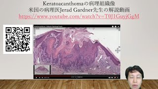 keratoacanthomaの病理組織像 [upl. by Benil]