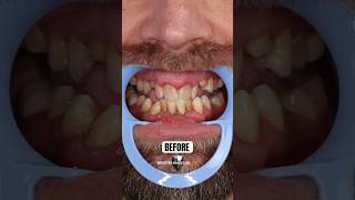 Snap On Veneers Before and After Results smiletransformation [upl. by Zashin]