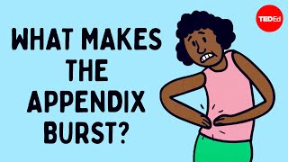 What does appendix pain feel like  David R Flum [upl. by Ahsilahk960]