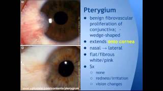 Pterygium vs Pinguecula quotEM in 5quot [upl. by Ilyse]