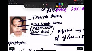 THALASSEMIA  PATHOLOGY  MBBSNEETPG INICET FMGE PREP HEMATOLOGY [upl. by Gnuoy]