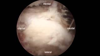 Endoscopic decompression for lumbar stenosis by UBE [upl. by Wattenberg489]