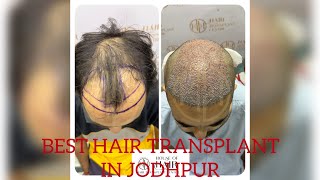 Best hair transplant clinic in jodhpur  HOH  Jaipur hair transplant India  hair transplant cost [upl. by Pravit977]