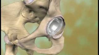 Medical animation Hip arthroplasty p1 [upl. by Scriven]