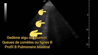 Oedème aigu du poumon Syndrome interstitiel Queues de comètes Lignes B Échographie Pulmonaire [upl. by Wardle]