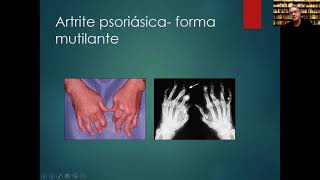 Artrite psoriasica e outras espondiloartrites [upl. by Llednar34]