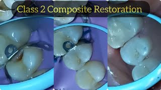 Composite Restoration of Class 2 Cavity in Upper Premolar  Posterior Composite Filling [upl. by Reger64]