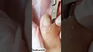 ingrown toenail removal [upl. by Gamages]