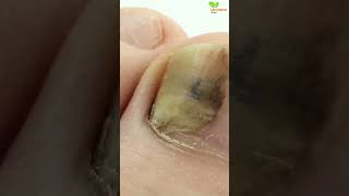 Eliminate Toenail Fungus Quickly Fast and Natural Solutions [upl. by Michale]