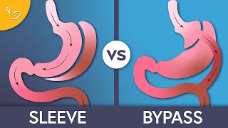 Gastric Sleeve vs Bypass Surgery Whats The Difference [upl. by Rome525]