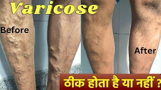 Varicose veins treatment with foam Sclerotherapy and Diode laser Result  varicose veins treatment [upl. by Lurlene463]