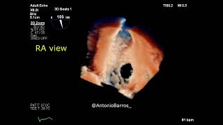 Ostium secundum ASD amp Atrial septal aneurysm  3D echocardiography [upl. by Beekman386]