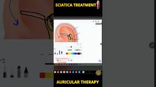 1 Second Relief in Sciatica साइटिका का अचूक इलाज Sciatica Nerve Pain shorts sciatica [upl. by Noval347]