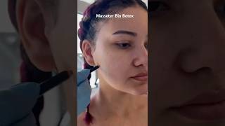 Masseter Bio Botox [upl. by Isaac43]