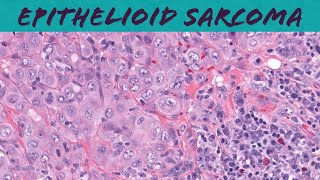 Epithelioid sarcoma explained in 5 minutes ‪ pathology dermpath dermatology dermatopathology [upl. by Innos]