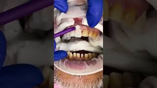 Want Perfect Veneers Watch This Now [upl. by Hcab]