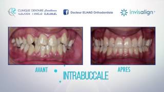 ‎invisalign‬  lalternative invisible aux bagues orthodontiques [upl. by Phyllis]