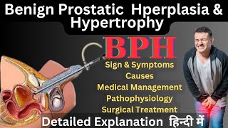 BPH Benign Prostatic Hperplasia and Hypertrophy in Hindi  Prostate Enlargement causes amp treatment [upl. by Scherman]