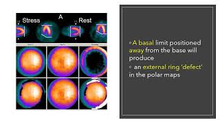 Artifacts in Nuclear Cardiology MCQs nuclearmedicineMCQ nuclearmedicine physics RSO frcr [upl. by Ponzo]