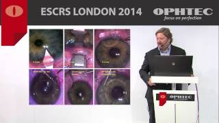 Zero astigmatism outcomes in Phakic IOL implantation by Prof M Pozharitsky Russia [upl. by Kciredec]