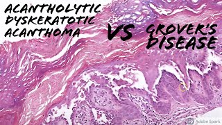 Acantholytic Dyskeratotic Acanthoma vs Grovers Disease 5Minute Pathology Pearls [upl. by Vinaya]