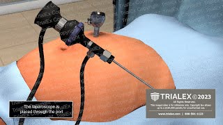 Insertion of Laparoscopic Trocar Animation [upl. by Malvie176]